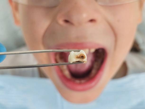Best Broken or Chipped Tooth Repair in Gardnerville, NV